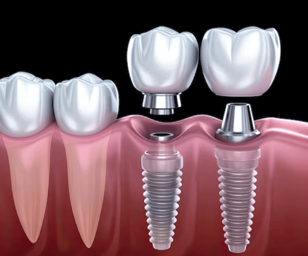 Dental Implant