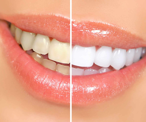 Teeth Whitening