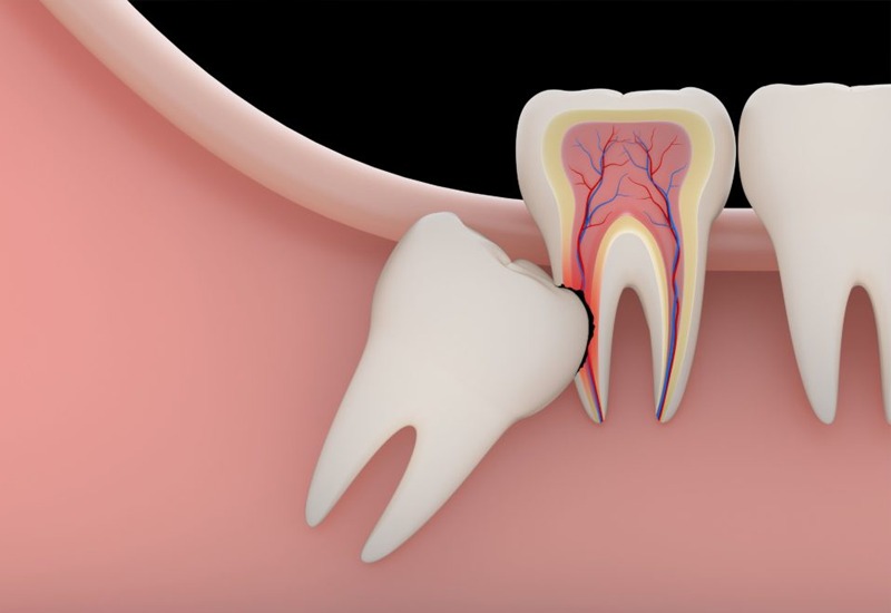 Tips for a quick salvage from sense tooth extraction