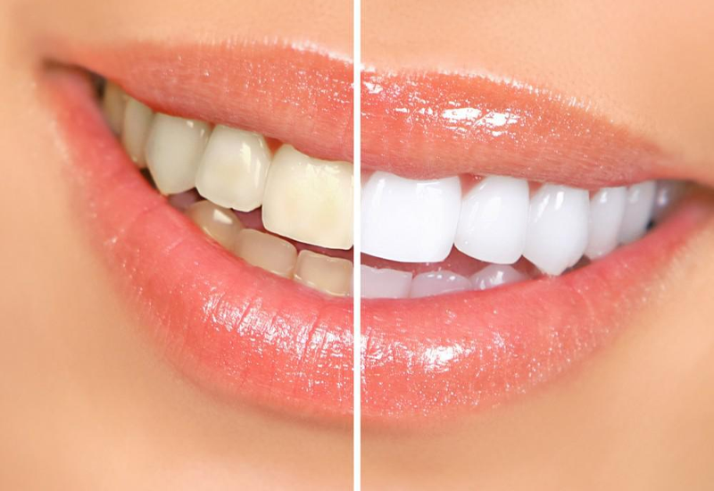 Is Professional Teeth Whitening worth it?