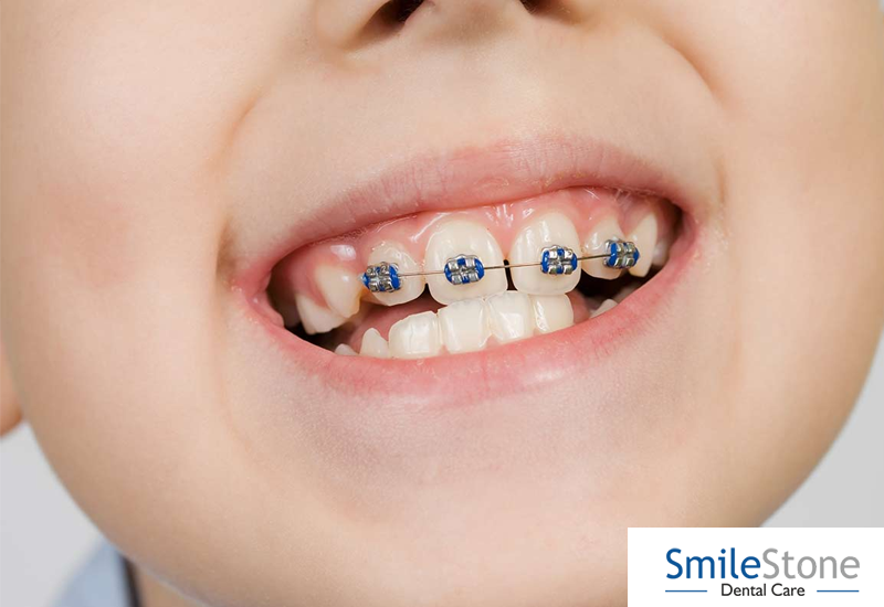 Your 1st Grader Needs a Braces Session This Summer