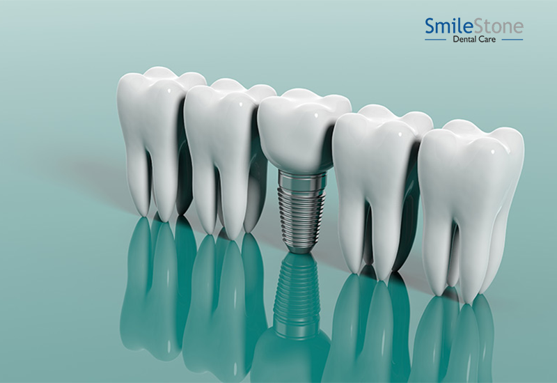 Endosteal implants: The Best Treatment to Restore your Lost Smile