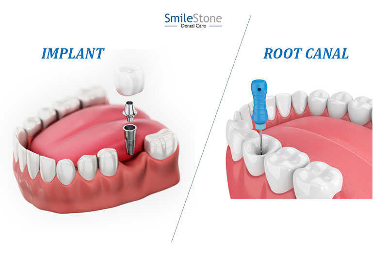 Which is the Safest and Fastest Treatment between Implants and Root Canal Treatment?