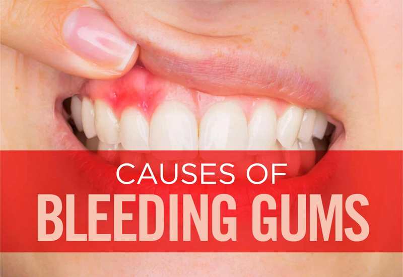 7 Causes of Bleeding Gums