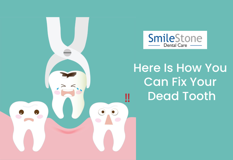 Here Is How You Can Fix Your Dead Tooth