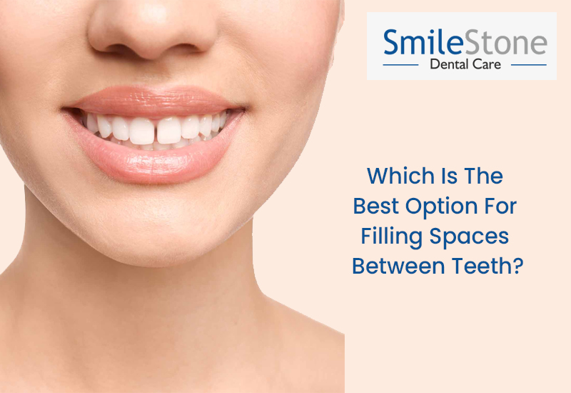 Which Is The Best Option For Filling Spaces Between Teeth?