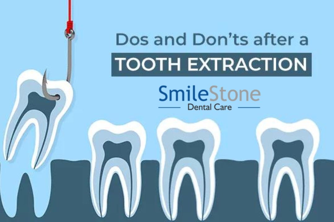 What are the Do’s and Don’ts after tooth extraction?