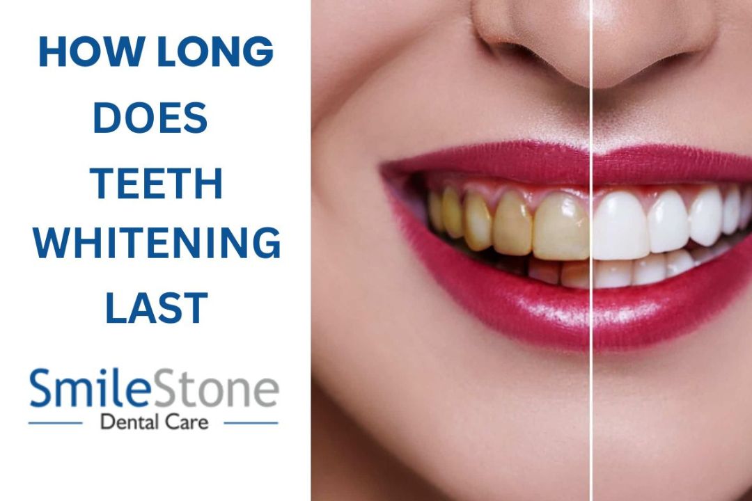 How long does Teeth Whitening last?