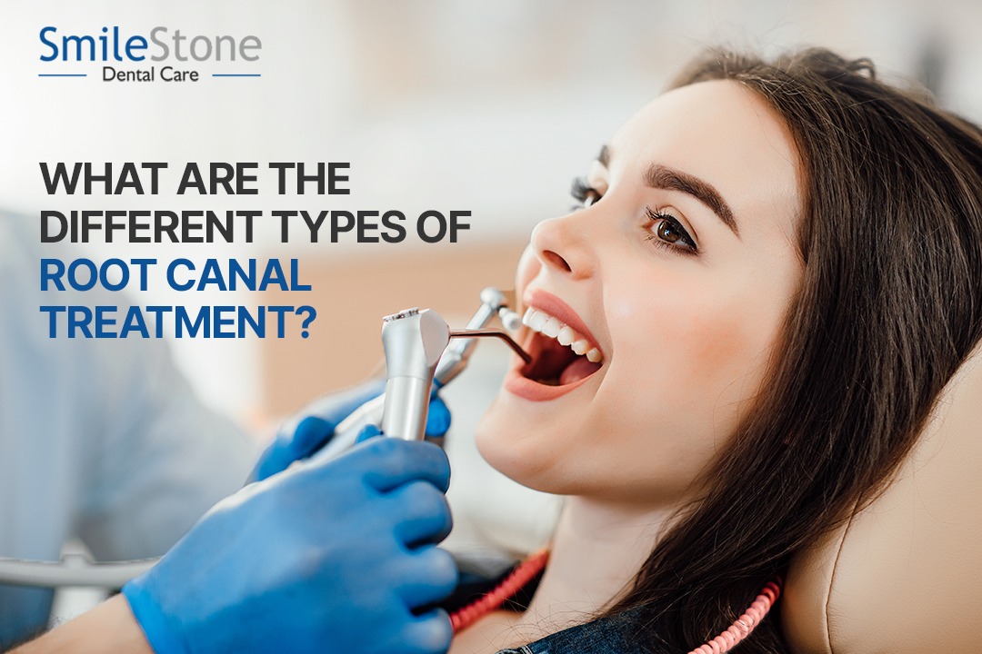 What are the different types of root canal treatment?