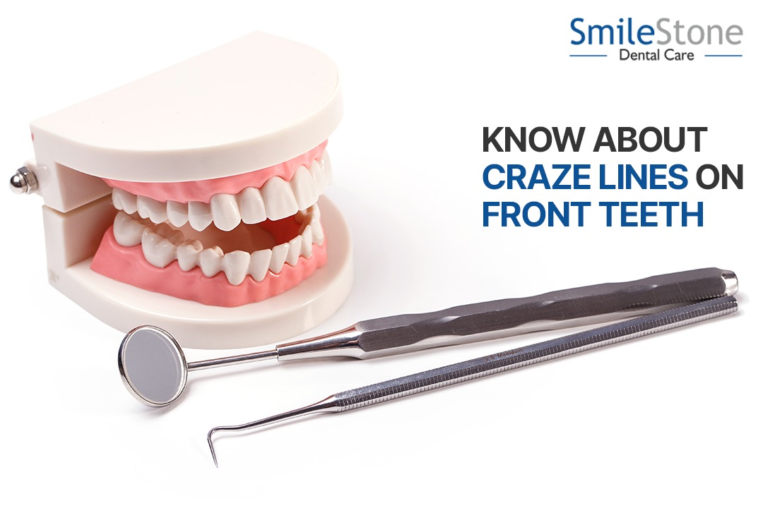 Know about Craze Lines on Front Teeth