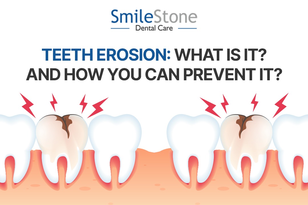 Teeth Erosion: What Is It? and How You Can Prevent It?