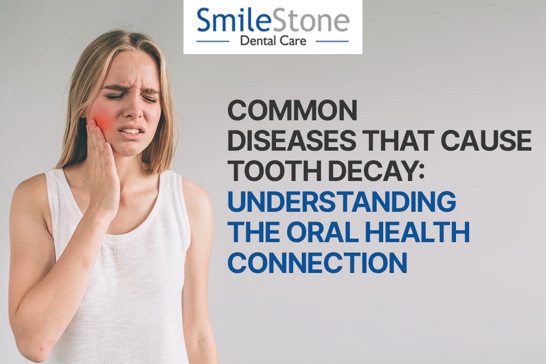 Common Diseases That Cause Tooth Decay: Understanding the Oral Health Connection