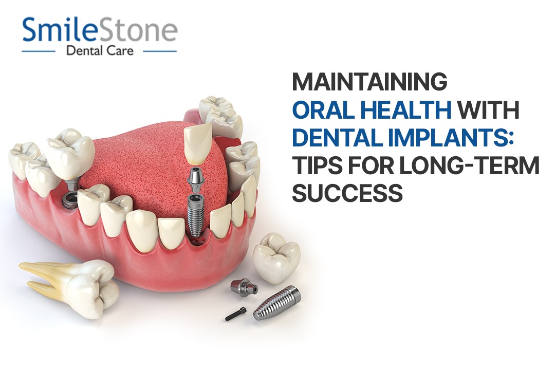 Maintaining Oral Health with Dental Implants: Tips for Long-Term Success