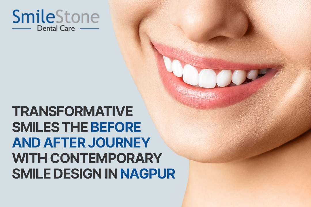 Transformative Smiles the Before and After Journey with Contemporary Smile Design in Nagpur