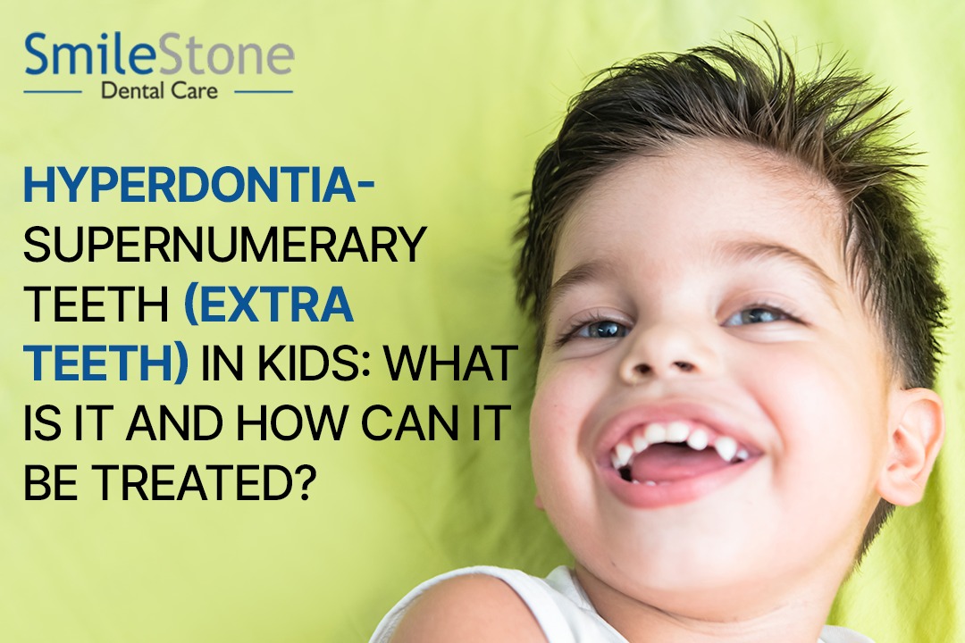 Hyperdontia -supernumerary teeth (extra teeth) in Kids: What Is It and How Can It Be Treated?