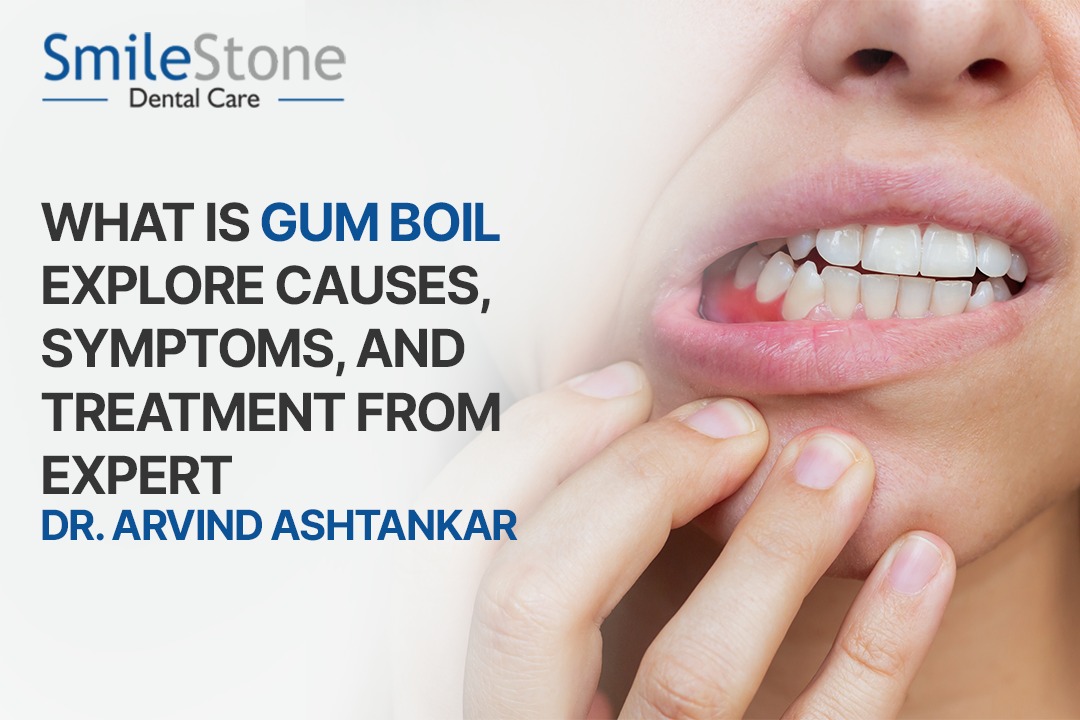 What Is Gum Boil Explore Causes, Symptoms, and Treatment from Expert Dr. Arvind Ashtankar