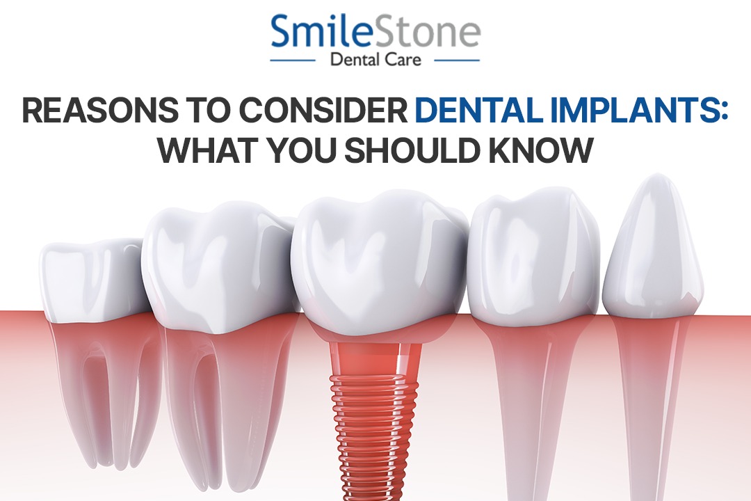 Reasons to Consider Dental Implants: What You Should Know