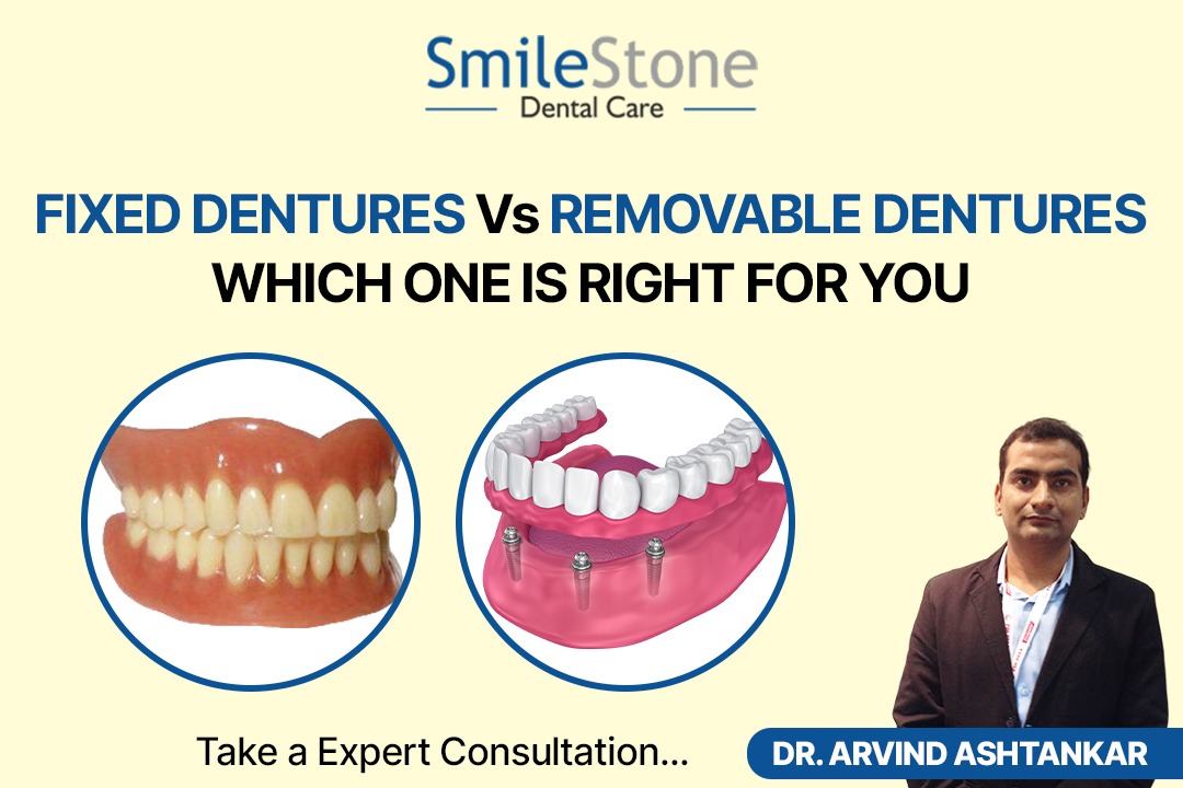 Fixed Dentures Vs Removable Dentures: Which One Is Right for You?