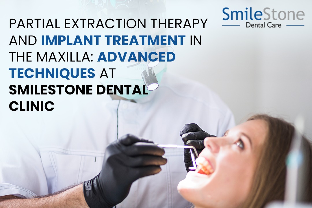 Partial Extraction Therapy and Implant Treatment in the Maxilla: Advanced Techniques at Smilestone Dental Clinic