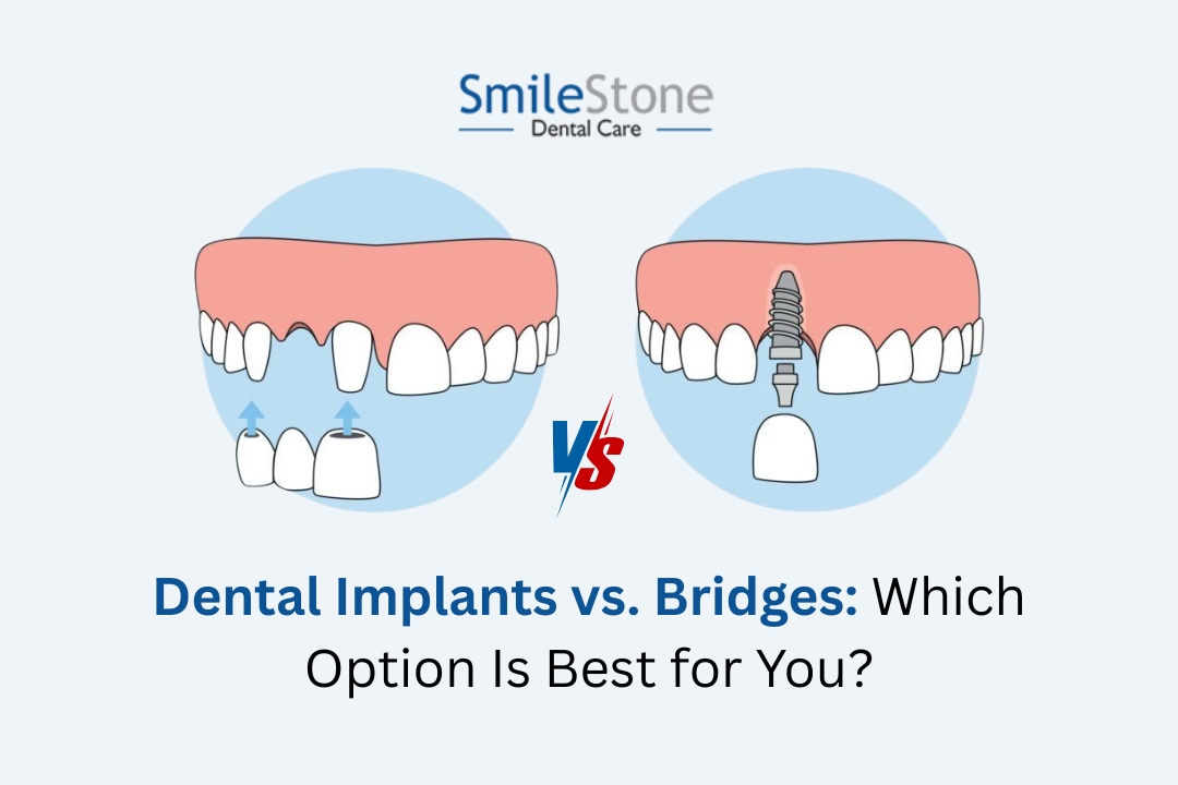 Dental Implants vs. Bridges: Which Option Is Best for You?