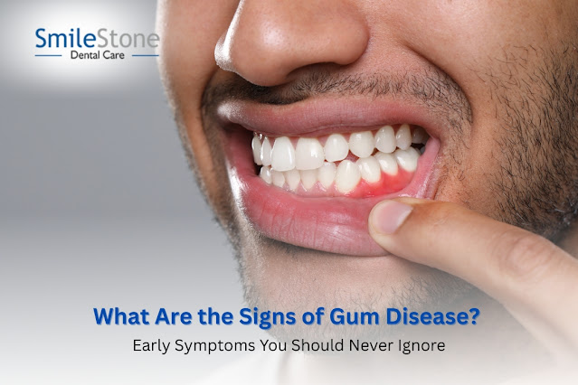 What Are the Signs of Gum Disease? Early Symptoms You Should Never Ignore