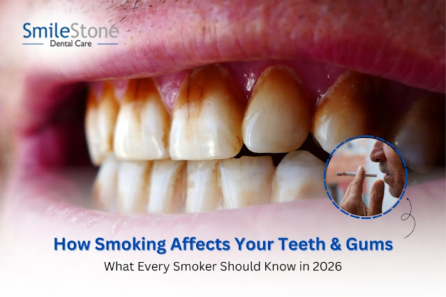 How Smoking Affects Your Teeth & Gums, What Every Smoker Should Know in 2026