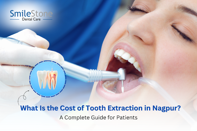What Is the Cost of Tooth Extraction in Nagpur? A Complete Guide for Patients