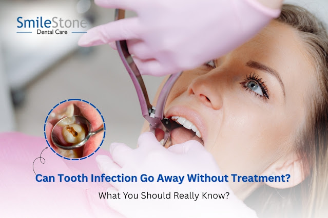 Can Tooth Infection Go Away Without Treatment? What You Should Really Know