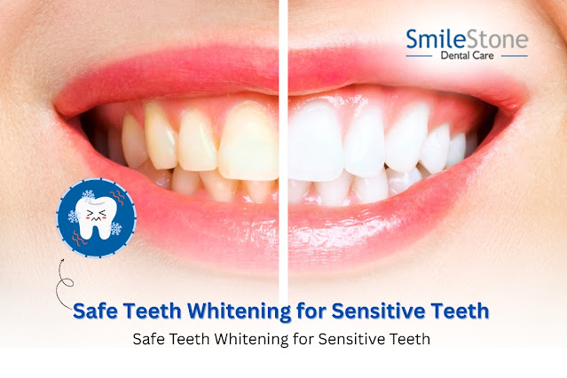 Safe Teeth Whitening for Sensitive Teeth – What You Should Know Before Treatment
