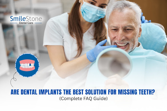 Are Dental Implants the Best Solution for Missing Teeth? (Complete FAQ Guide)