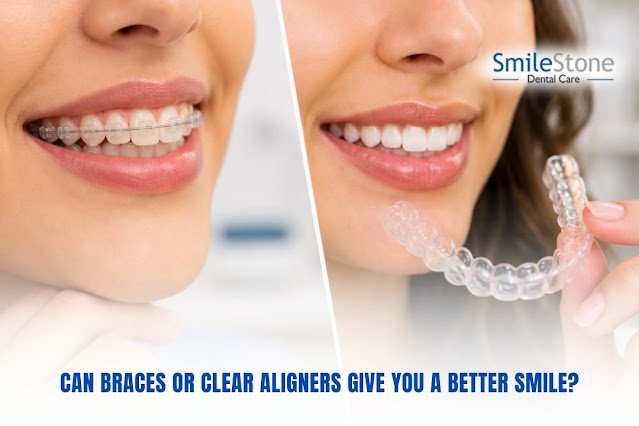 Can Braces or Clear Aligners Give You a Better Smile?