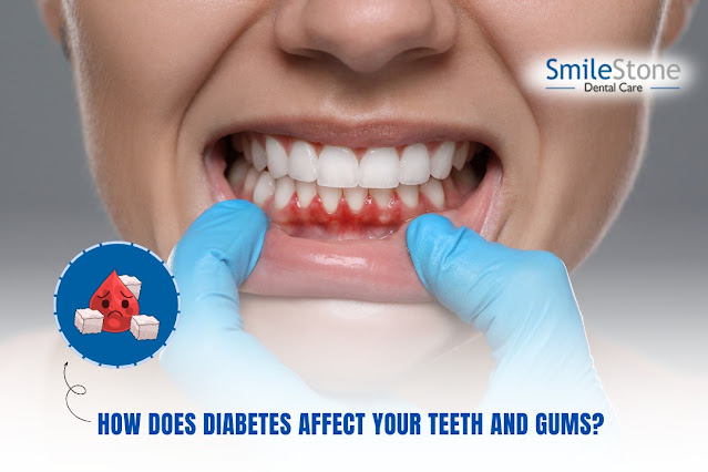 How Does Diabetes Affect Your Teeth and Gums? A Complete Guide