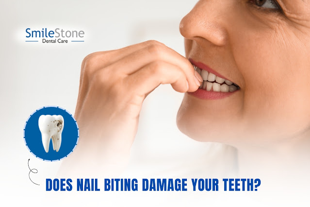 Does Nail Biting Damage Your Teeth? Everything You Need to Know