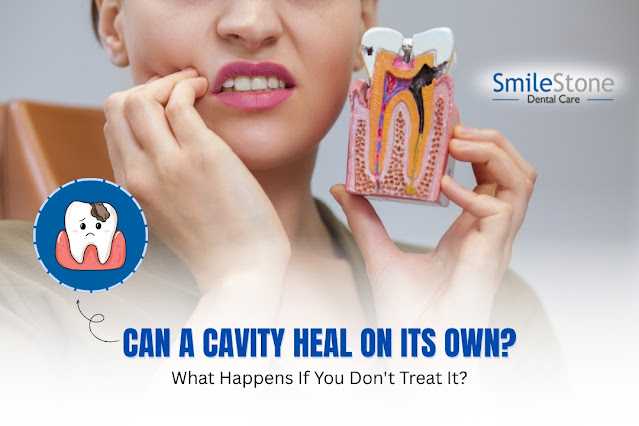 Can a Cavity Heal on Its Own? What Happens If You Don't Treat It?