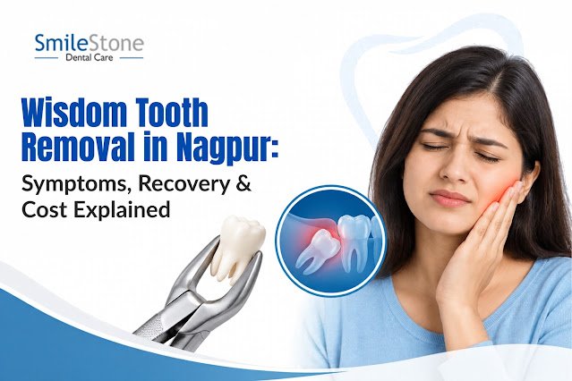 Wisdom Tooth Removal in Nagpur: Symptoms, Recovery & Cost Explained