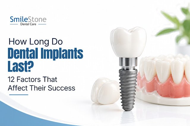 How Long Do Dental Implants Last? 12 Factors That Affect Their Success