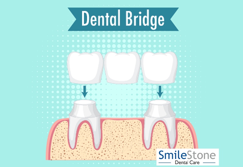 How Is A Cantilever Dental Bridge Dissimilar From Other Bridges?